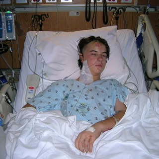 Alex in the hospital after surgery awake with bandage on head removed