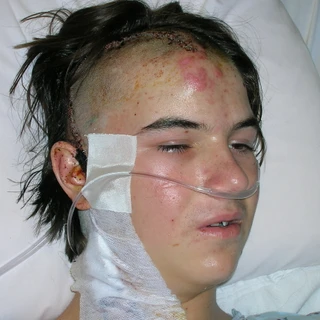 Alex in the hospital after surgery