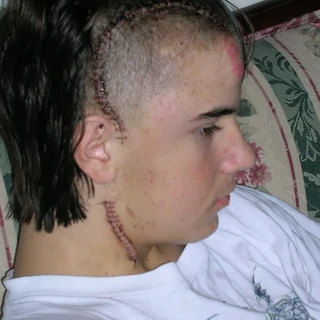 Alex's stictches and staples