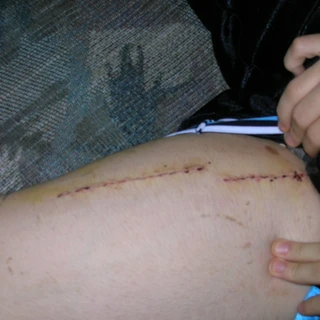 Alex's stictches in his leg
