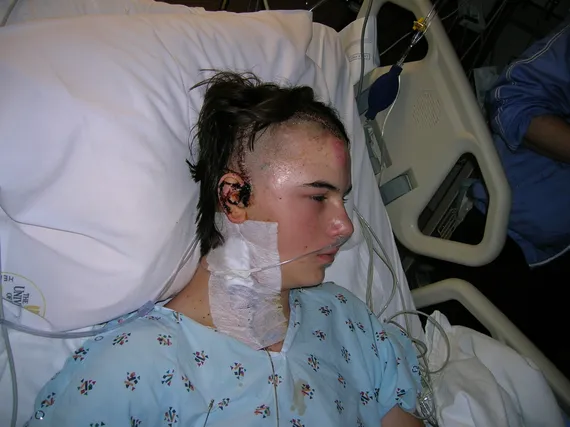 Alex in the hospital after surgery showing staples on head