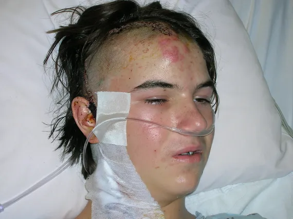 Alex in the hospital after surgery