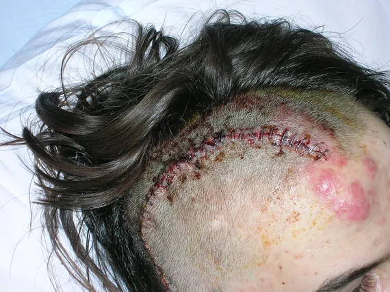 Close up of staples in Alex's head