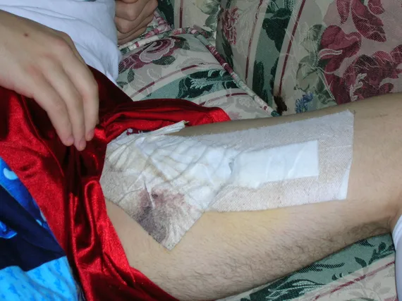 Close up of bandages on Alex's leg