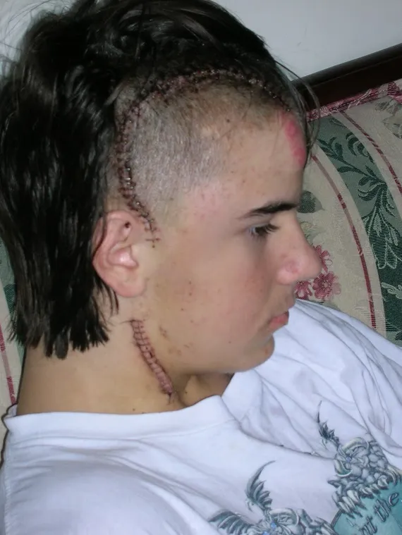 Alex's stictches and staples