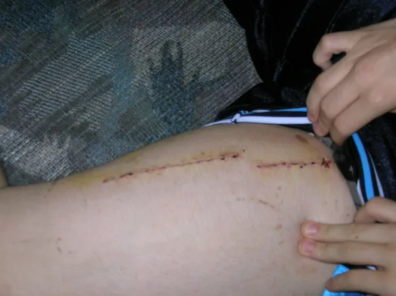 Alex's stictches in his leg
